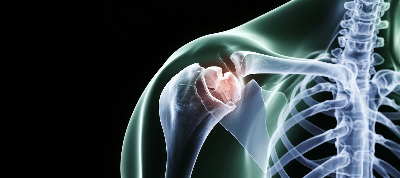 Best Shoulder Replacement Surgery in Delhi: Advanced Procedure, Cost, Recovery & Expert Orthopedic Care